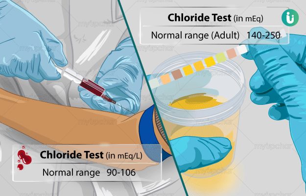 آزمایش کلر در خون و ادرار (Chloride Test)